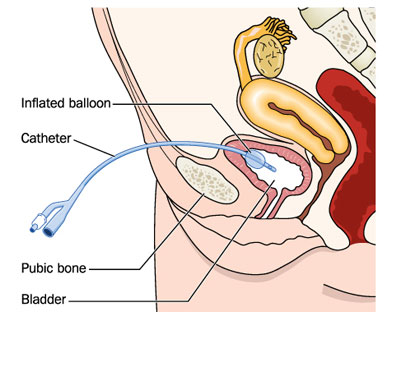 Urethral Stricture Surgery In Nashik
