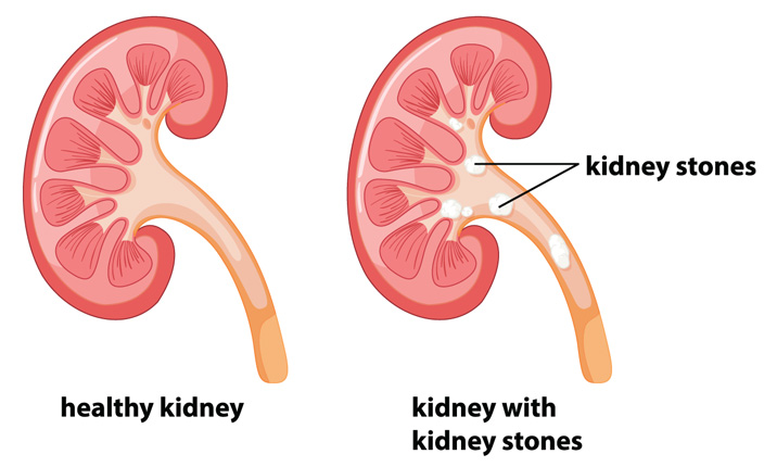 Kidney Stones Treatment In Nashik | Dr Sudarshan Daga