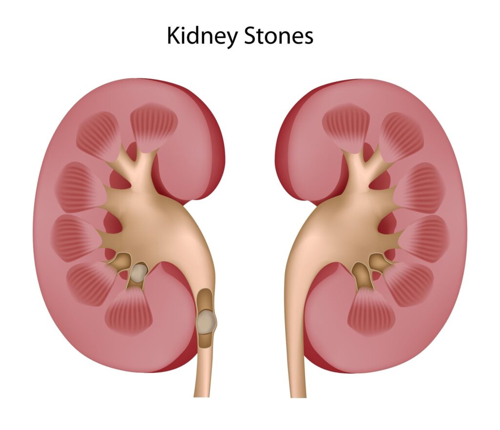 Laser Treatment For Kidney Stone In Nashik | Dr Sudarshan Daga